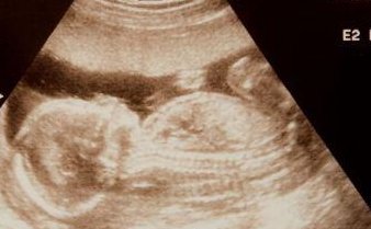 在新密市做试管婴儿长方案周期需要多久？超长方案促排流程是怎么样的？